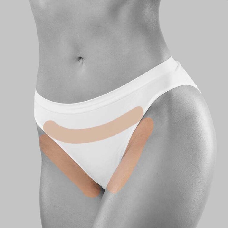 Épilation laser bikini artistique CLINIQUE SKINS