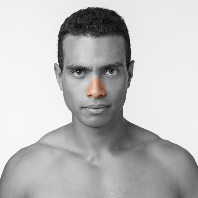 Épilation laser nez CLINIQUE SKINS